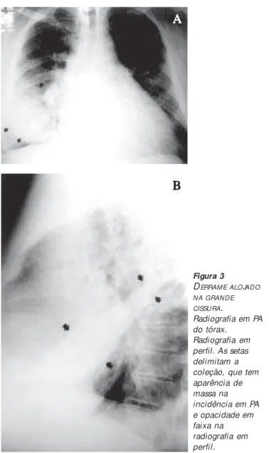 Figura 2 D ERRAME ALOJADO NA PEQUENA CISSURA . A) Radiografia em PA. B) Radiografia em perfil
