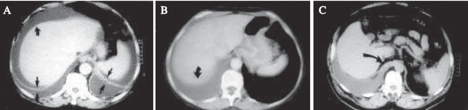 Figura 8 –  S INAIS TOMOGRÁFICOS DE DERRAME PLEURAL . A) TC com cortes de 10mm de espessura de homem de 62 anos com derrame pleural bilateral e líquido ascítico secundários à pancreatite