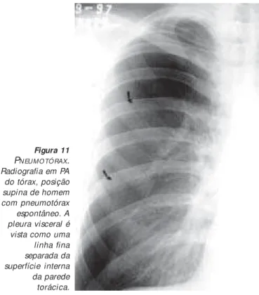 Figura 12 –  P NEUMOTÓRAX .  TCAR com cortes de 1mm de espessura no ápice pulmonar de homem de 18 anos, apresentando o 2º episódio de pneumotórax