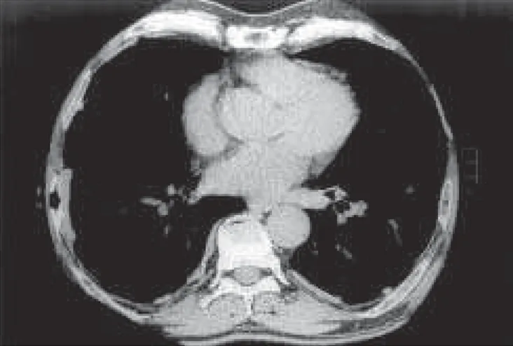 Figura 16 T UMOR FIBROSO LOCALIZADO DA PLEURA . Radiografias do tórax em PA (A) e perfil (B) de homem de 52 anos