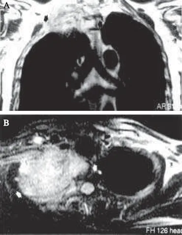 Figura 18 F IBROTÓRAX . Radiografia do tórax em PA de homem de 60 anos com fibrotórax por seqüela de tuberculose