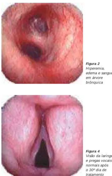 Figura 1 – Visão da laringe com comprometimento das pregas vocais
