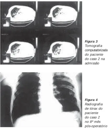 Figura 2 Radiografia de tórax do paciente do caso 2 na admissão Figura 3 Tomografia computadorizadado paciente do caso 2 na admissão Figura 4 Radiografia de tórax do paciente do caso 2 no 8º mês pós-operatório