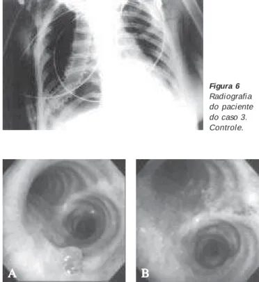 Figura 7 – Broncoscopia do paciente do caso 3 no 3º mês de pós- pós-operatório. A) Granuloma de 5mm na parede brônquica