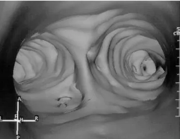Figura 3 – Imagem de TC: broncoscopia virtual com visão da cari- cari-na, demonstrando os orifícios dos divertículos traqueobrônquicos.
