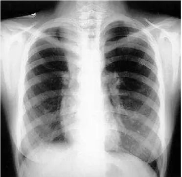 Figura 6 – TC espiral corte transverso no ápice pulmonar demons- demons-trando imagens císticas paratraqueal direita e parede posterior,  al-gumas em contiguidade com a luz traqueal