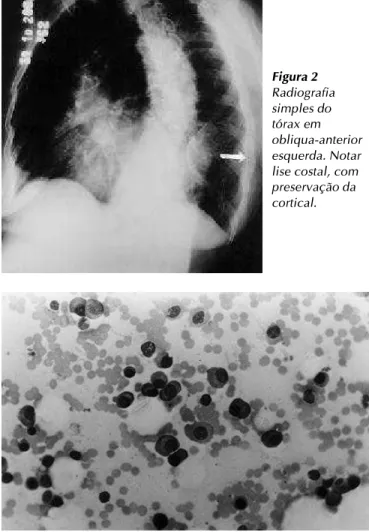 Figura 1 Radiografia simples do tórax em póstero-anterior Figura 2 Radiografiasimples dotórax em obliqua-anterioresquerda