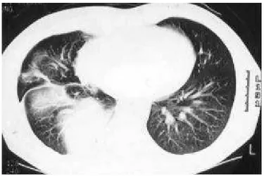 Figura 1  – Radiografia (póstero-anterior) do tórax que evidencia derrame pleural à direita e vários nódulos pulmonares à esquerda