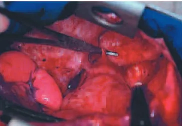 Figura 1 – Arteriografia mostrando a artéria sistêmica anômala em direção ao lobo inferior direito