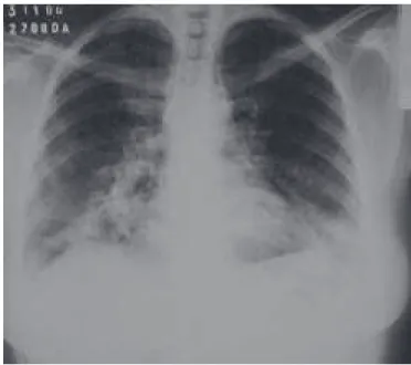 Figura 1 – Radiografia da admissão Figura 2 – Radiografia um mês após a Figura 1