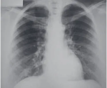 Figura 3 – Fotomicrografia da biópsia pulmonar mostrando espaço alveolar e luz bronquiolar preenchidos por numerosos macrófagos e eosinófilos