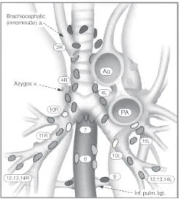Figura 2 – Estações nodais regionais para estadiamento do câncer do pulmão. Visão da janela aorto-pulmonar.
