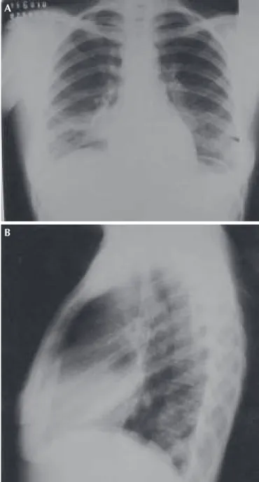 Figura 2 – Tomografia computadorizada de tórax