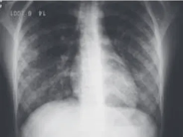 Figura 2 – Radiografia de tórax 24 horas após internação mostran- mostran-do maior confluência das consolidações