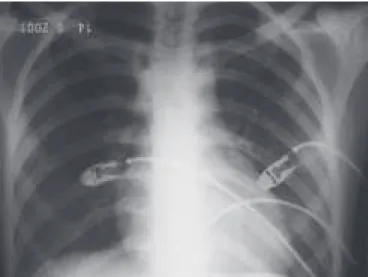 Figura 3 – Radiografia torácica sete dias após com resolução radio- radio-lógica