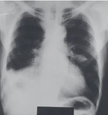 Figura 2 – Caso 1: tomografia computadorizada de tórax. Massa lobulada na língula, espiculada e sem calcificações; derrame  pleu-ral à direita.