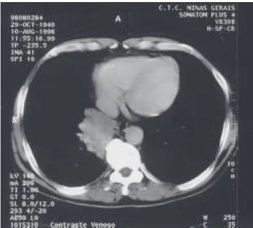 Figura 3 – Caso 2: tomografia computadorizada de tórax. Grande massa bocelada localizada em lobo inferior direito, em contato com coluna vertebral.