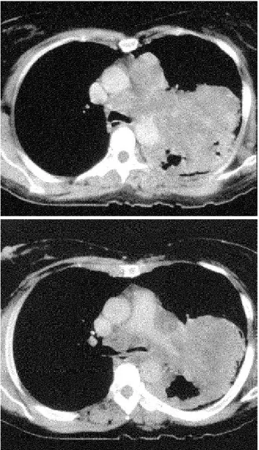 Figura 3  –  Imagem de RM no plano coronal, com ponderação em T1, mostrando tumor pulmonar comprometendo o brônquio  prin-cipal esquerdo, distando menos de 2cm