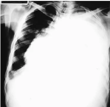 Figura 1  Radiografia de tórax realizada uma semana após a inter- inter-nação