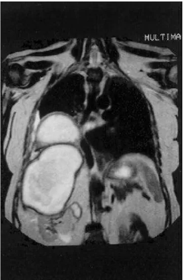 Figura 2  – Ressonância magnética (plano sagital): observar fígado rechaçado anteriormente pelo grande abscesso retroperitoneal, abscesso pulmonar e derrame pleural.
