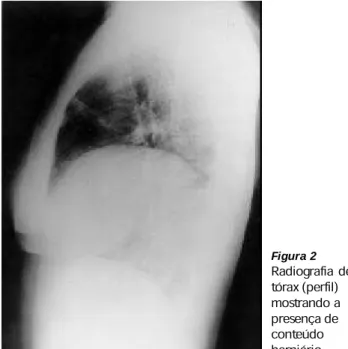 Figura 1  – Radiografia de tórax (póstero-anterior) mostrando a pre- pre-sença de conteúdo herniário
