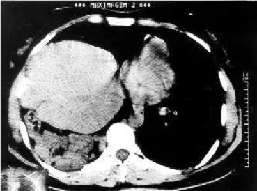 Figura 4  – Tomografia computadorizada de tórax mostrando, ao