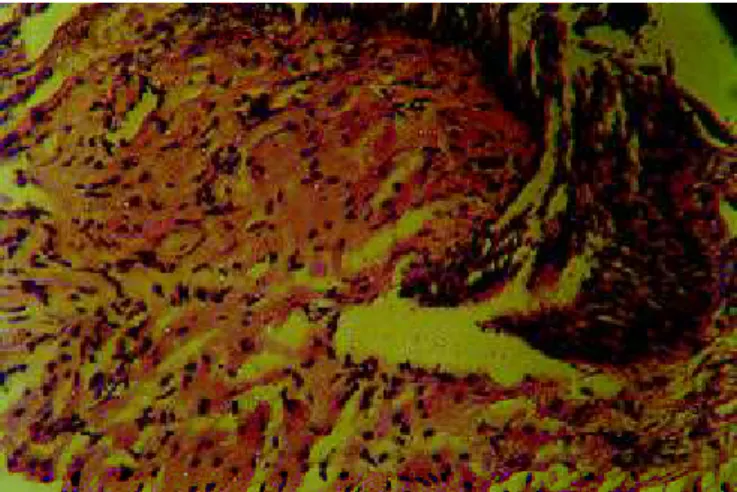 Figura 1 Fibrobroncoscopia evidenciando hiperemia, elevação e irregularidade da mucosa