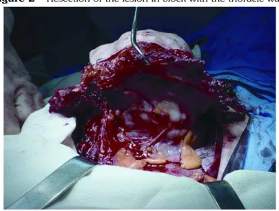Figure 2 – Resection of the lesion in block with the thoracic wall. 