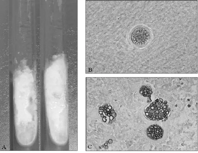 Figure 2 – Progression of the pulmonary infiltrates  during the patient’s stay in the intensive therapy unit 