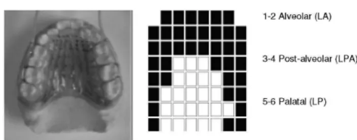 Figure 1. Artificial palate showing the 62 electrodes. To the right, the  palatogram of the alveolar phone [t], demonstrating the regions of  pos-sible contact between tongue and palate, black squares show effective  contact and white ones non effective