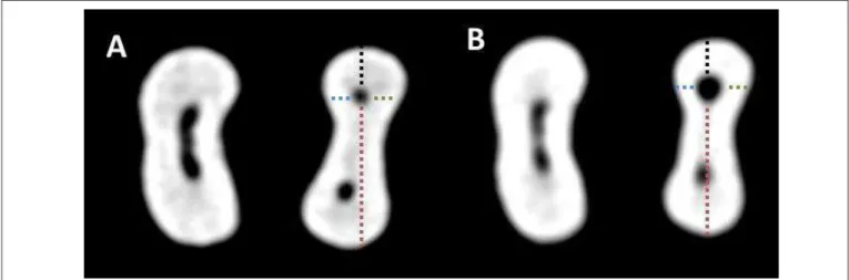 Fig. 1. CBCT scan images showing the centering ability of the ProTaper Universal™ before (A) and after (B) preparation at apical level.