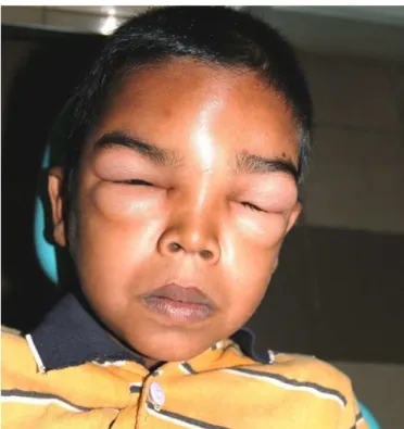 Fig. 1. A 7-year-old boy exhibiting diffuse facial swelling involving forehead and both the eyes.
