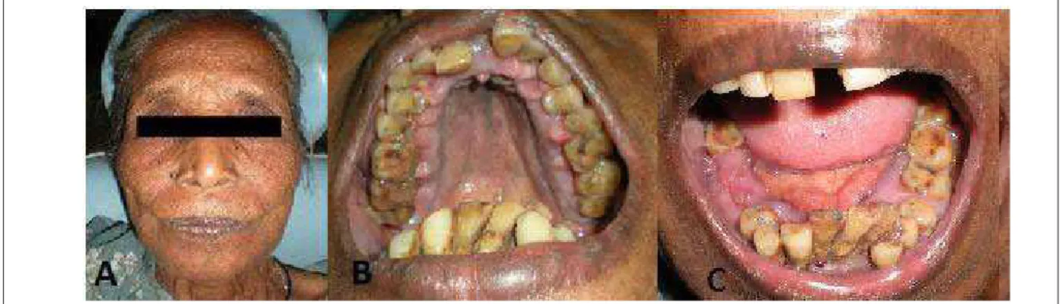 Fig. 1-  A. Extraoral view, B and C: Intraoral views showing gingival enlargement.