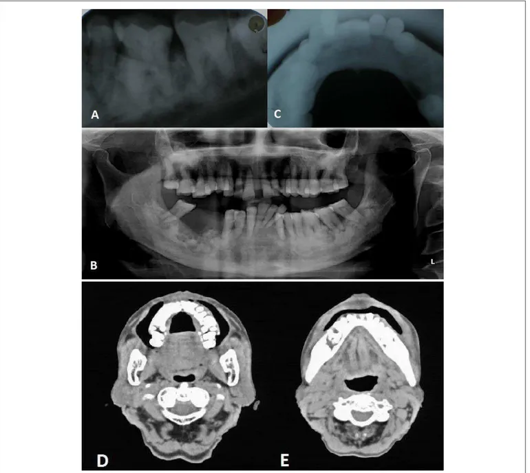 Fig. 2- A. Periapical view; B: Panoramic View; C: Occlusal view showing multiple ill-defined, varying size radiopaque areas of calcification in premolar and molar region;