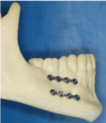 Fig. 2. Group 2: An Erich arch bar in the compression zone and one 2.0 mm mini- mini-plate in the neutral zone.