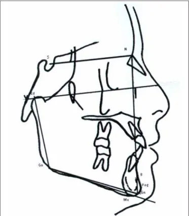 Fig. 1. Cephalogram illustrating angular measurements used in the study: SNB, SND, SNGoGn, SNGoMe, CdGoGn, Y-axis, Face angle and FMA.