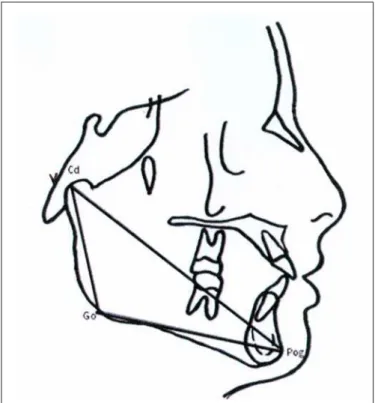Fig. 2. Cephalogram showing linear measurements (mm) used in the study: