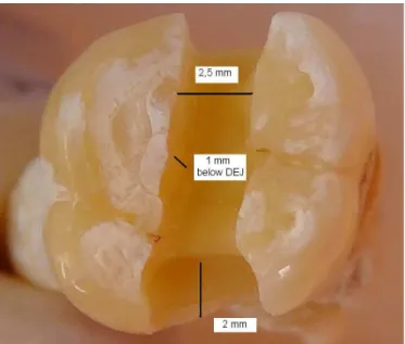 Fig. 2. Microtome cut. The degree of dye penetration is evident at the interfaces: