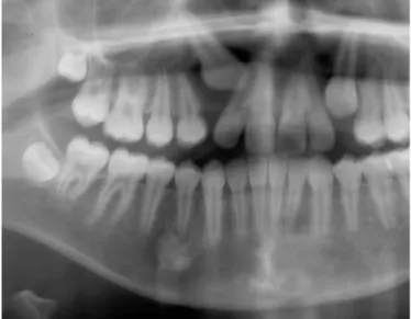 Fig. 1. Palatally impacted right maxillary canine and idiopathic osteosclerosis in the right mandibular first premolar region.