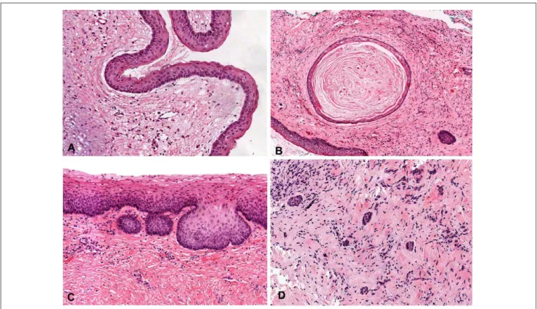 Fig. 2: A. Typical epithelium lining of a KCOT (H.E., 10.3X). B. Daughter cyst observed in cystic capsule (H.E., 4.8X)