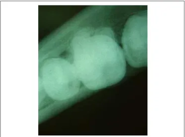 Fig. 5 - Lateralized occlusal radiographic image, without changes in vestibular or lingual cortical.