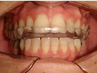 Fig. 3 - Occlusal splint installed.
