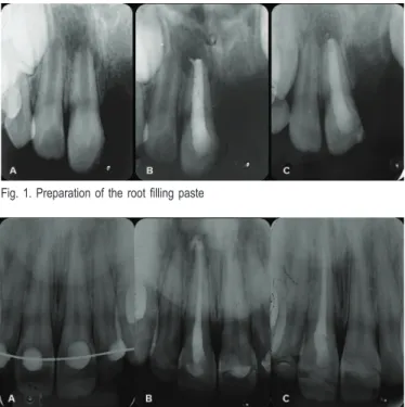 Fig. 1. Preparation of the root filling paste