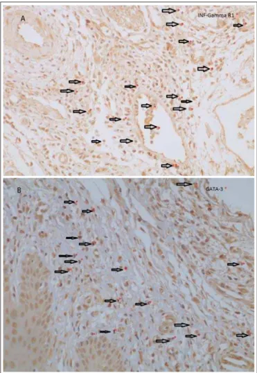 Fig. 1. Test Group: 1A - inflammatory infiltrate showing immunostaining to IFN-γ R1 subunit of the receptor for IFN- γ  (200x)
