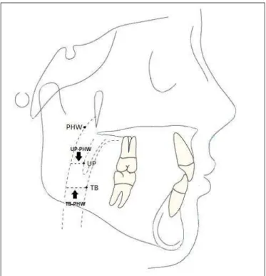 Fig 1. Points and reference lines used in the study. PHW = pharyngeal wall; UP = lower portion of the soft palate; TB = tongue base.