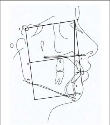 Fig. 1- Cephalogram showing linear measurements (mm) S’-ENA, S’-Pog, Palatal Plane, Go-Gn, 1-NA, 1-NB, overjet and overbite.