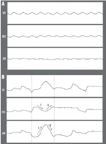 Figure 1. Waveform traces from Vt, from rib cage displacement (RC)  and  abdomen  (AB)