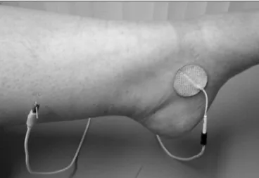 Figure 2. Needle and adhesive reference electrodes with cables from  the electrical stimulator.