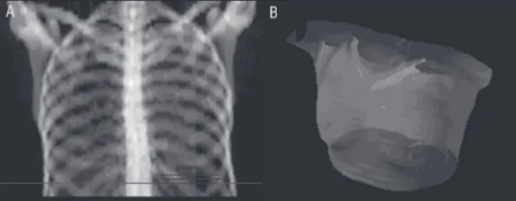 Figure 5.  3D reconstruction of the final pleural effusion volume of a  control group patient
