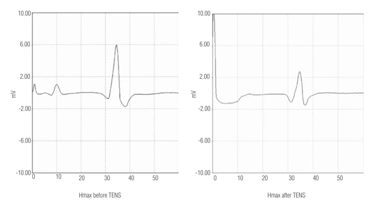 Figure 1. Hmax after and before application of TENS.